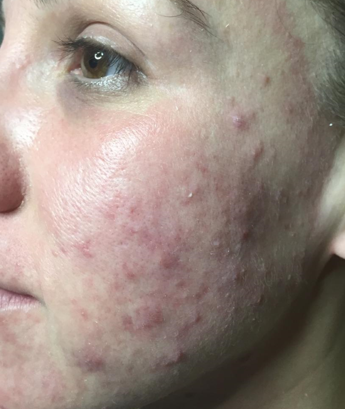 Yvette Before Picture